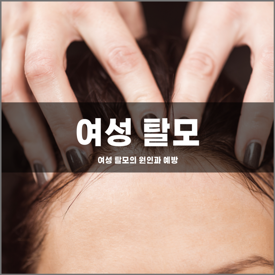 Causes and Prevention of Hair Loss in Women